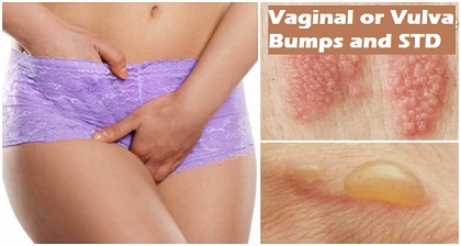 std and vagina bump